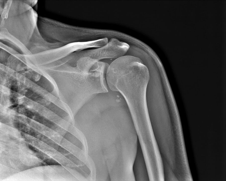 Radiografia dell'artrosi dell'articolazione della spalla, 2° grado di gravità