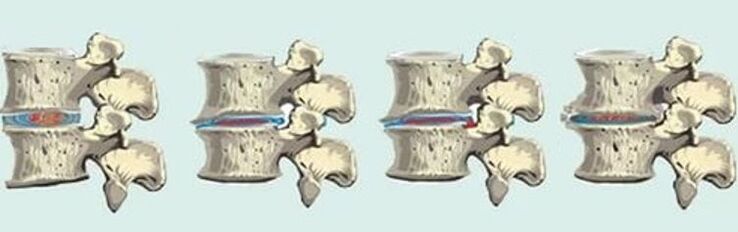 Lesione spinale nell'osteocondrosi toracica