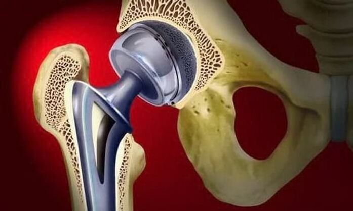 Sostituzione dell'anca per l'artrosi