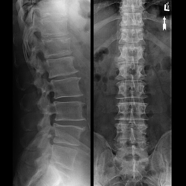 Radiografia del torace che mostra una diminuzione dello spazio tra le vertebre dal basso verso l'alto lungo la colonna vertebrale