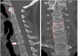 La TC mostra vertebre e dischi intervertebrali danneggiati di altezza eterogenea a causa di osteocondrosi toracica