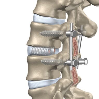 Sostituzione di un disco intervertebrale distrutto della colonna vertebrale toracica con un impianto artificiale