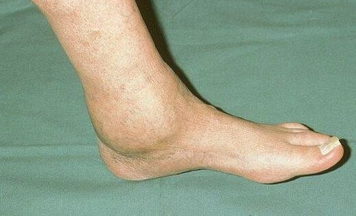 Gonfiore dell'articolazione della caviglia con artrosi