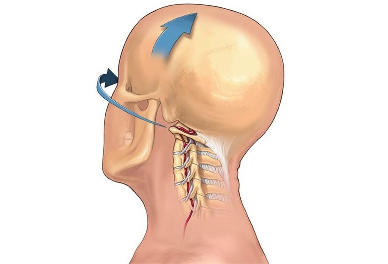 Digrignamento del collo quando si gira la testa come sintomo di osteocondrosi cervicale