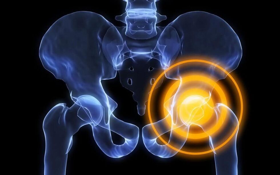 Immagine del dolore alle articolazioni dell'anca 2