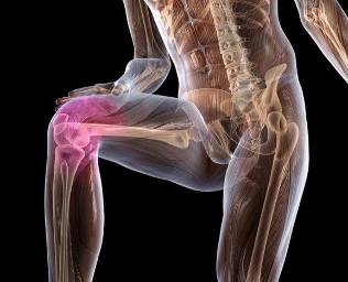 Infiammazione dell'articolazione del ginocchio con osteoartrite