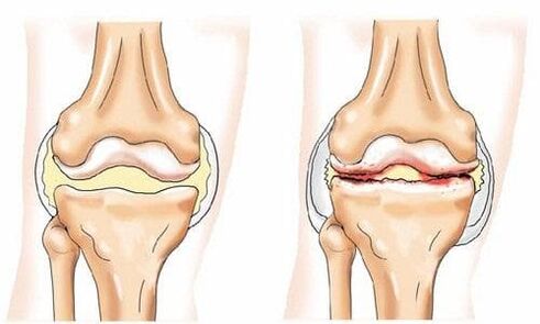 articolazione del ginocchio sana affetta da osteoartrosi