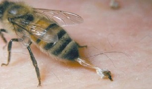 Trattamento dell'osteoartrosi dell'anca da parte delle api
