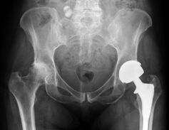 Diagnosi dell'artrosi dell'articolazione dell'anca